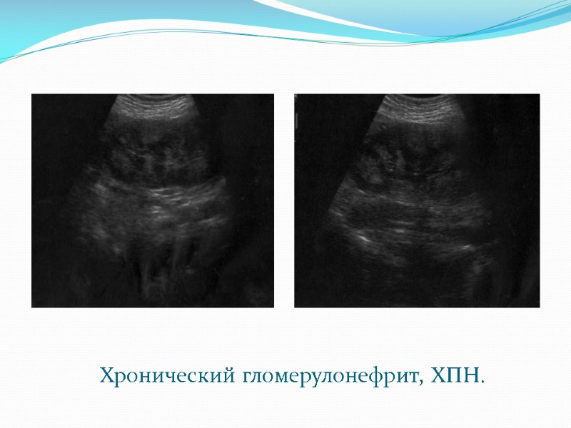 Хронический гломерулонефрит, ХПН.